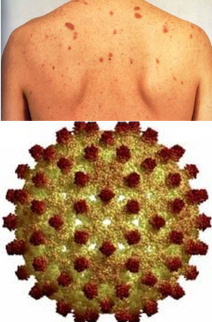 hepatit b